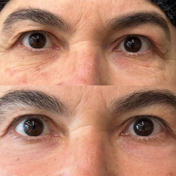 Antes e depois Dr Giovanni mulher olhando de frente