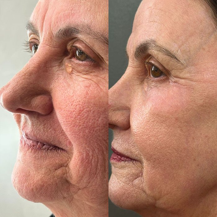 Antes e depois Dr Giovanni mulher olho castanho