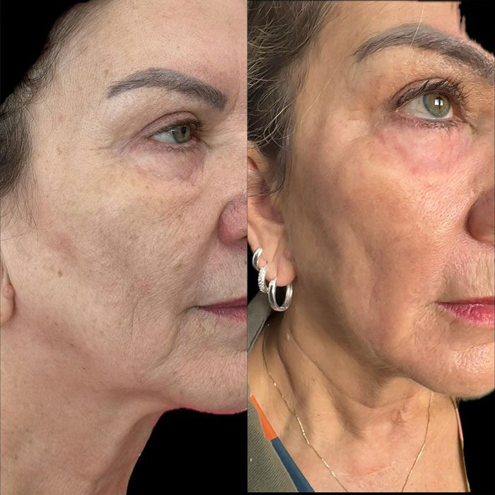 Antes e depois Dr Giovanni mulher olho verde